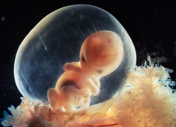 Gemenii sunt „anomalii fetale severe” pentru un medic aborţionist din America