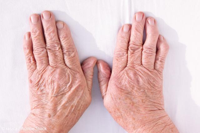 Leacurile bunicii pentru ameliorarea durerilor reumatice